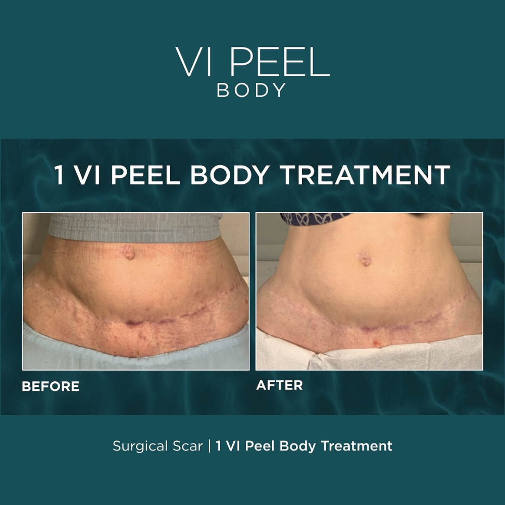 VI Peel® Body