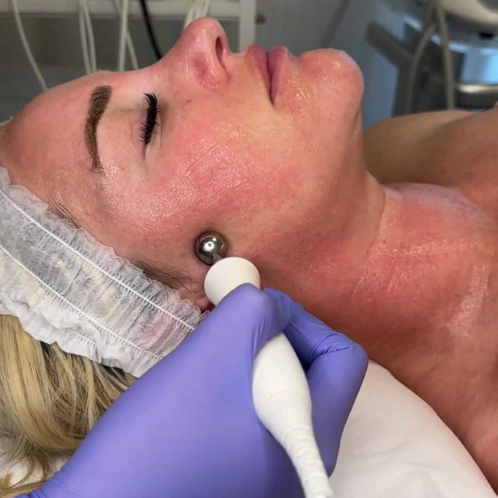 Carboxy Lift Treatment