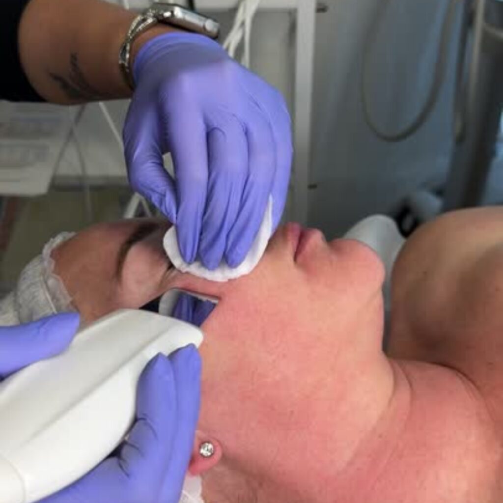 Carboxy Lift Treatment