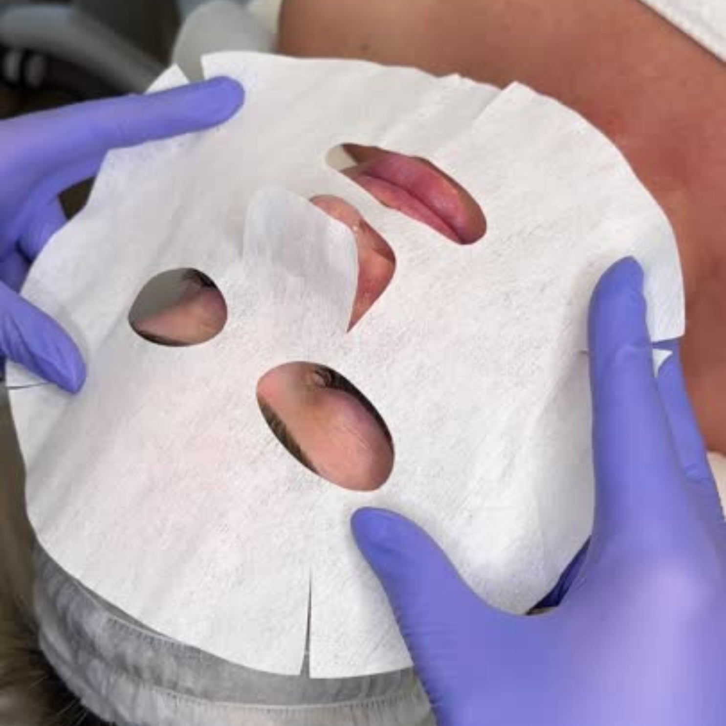 Carboxy Lift Treatment