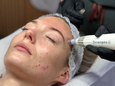 Dermapen®4 Microneedling