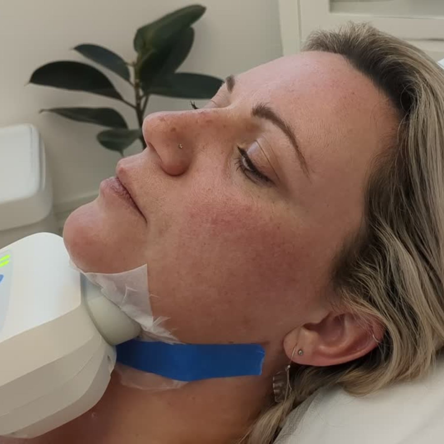 Double Chin Reduction