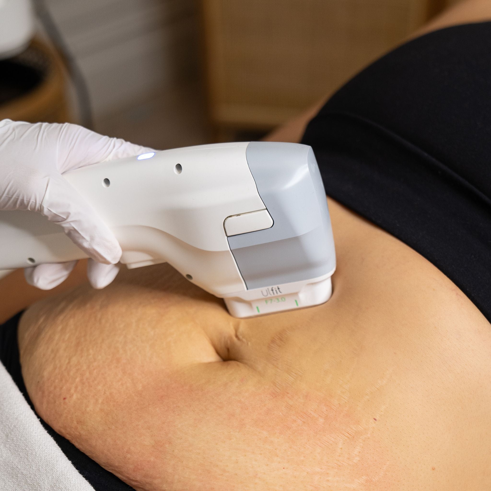 Ulfit® HIFU Body Contouring