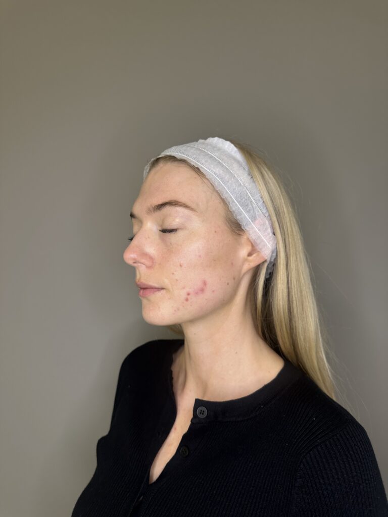 Dermapen®4 Microneedling