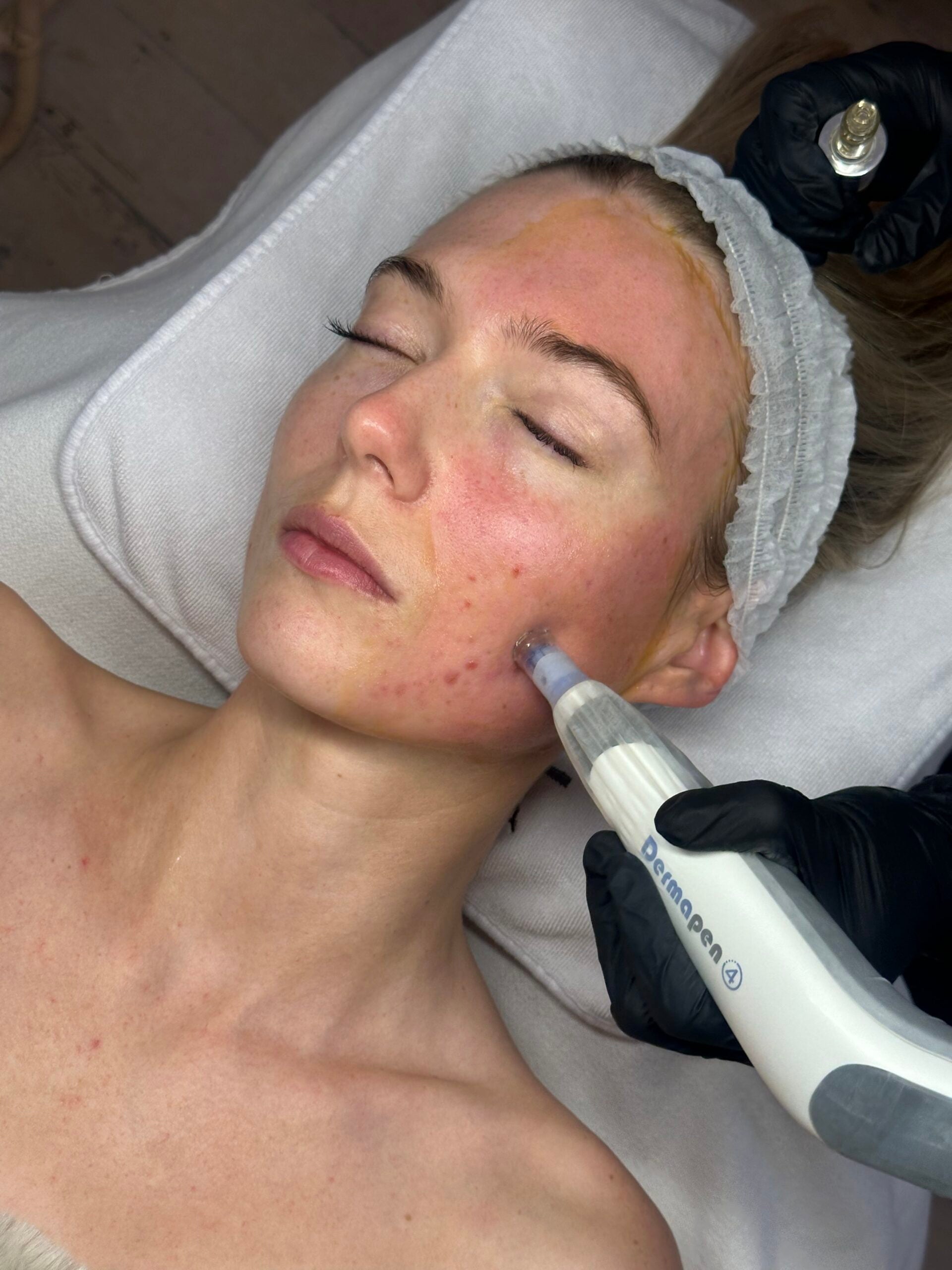 Dermapen®4 Microneedling