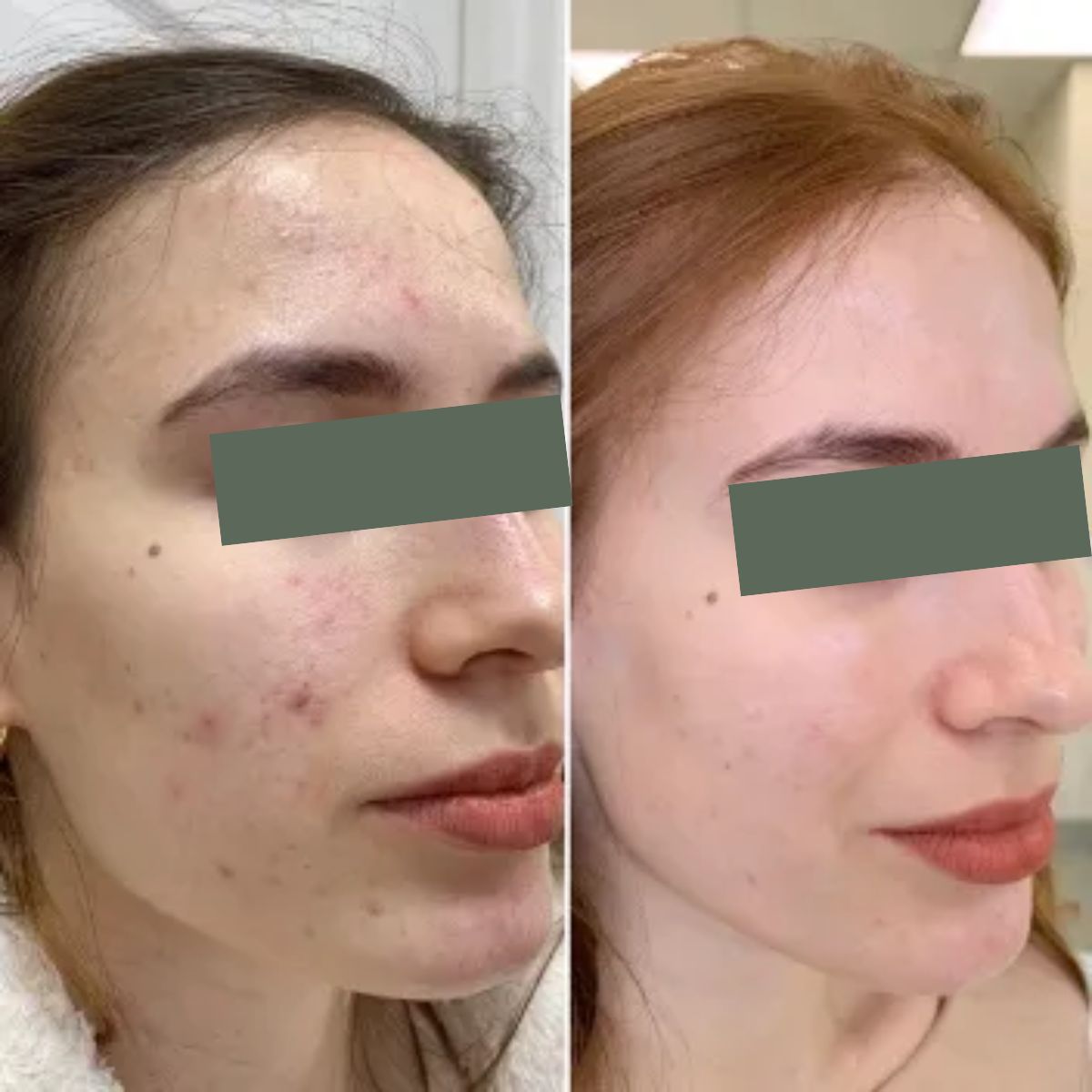 PRP (Platelet-rich plasma)