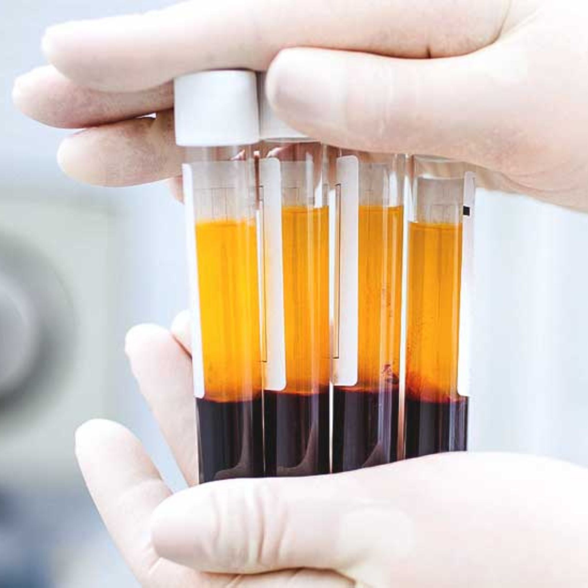PRP (Platelet-rich plasma)