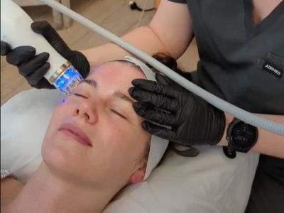 RF Microneedling