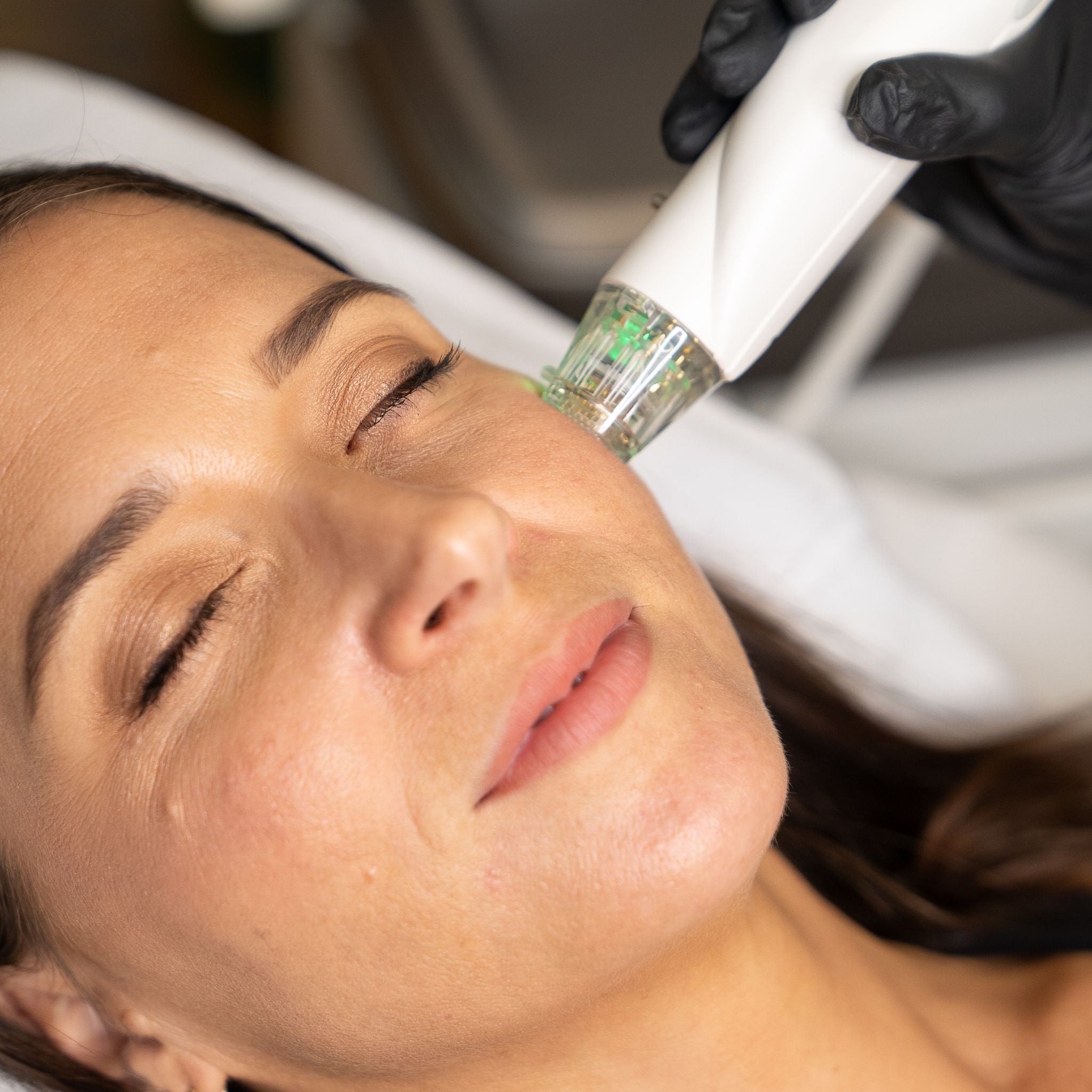 RF Microneedling