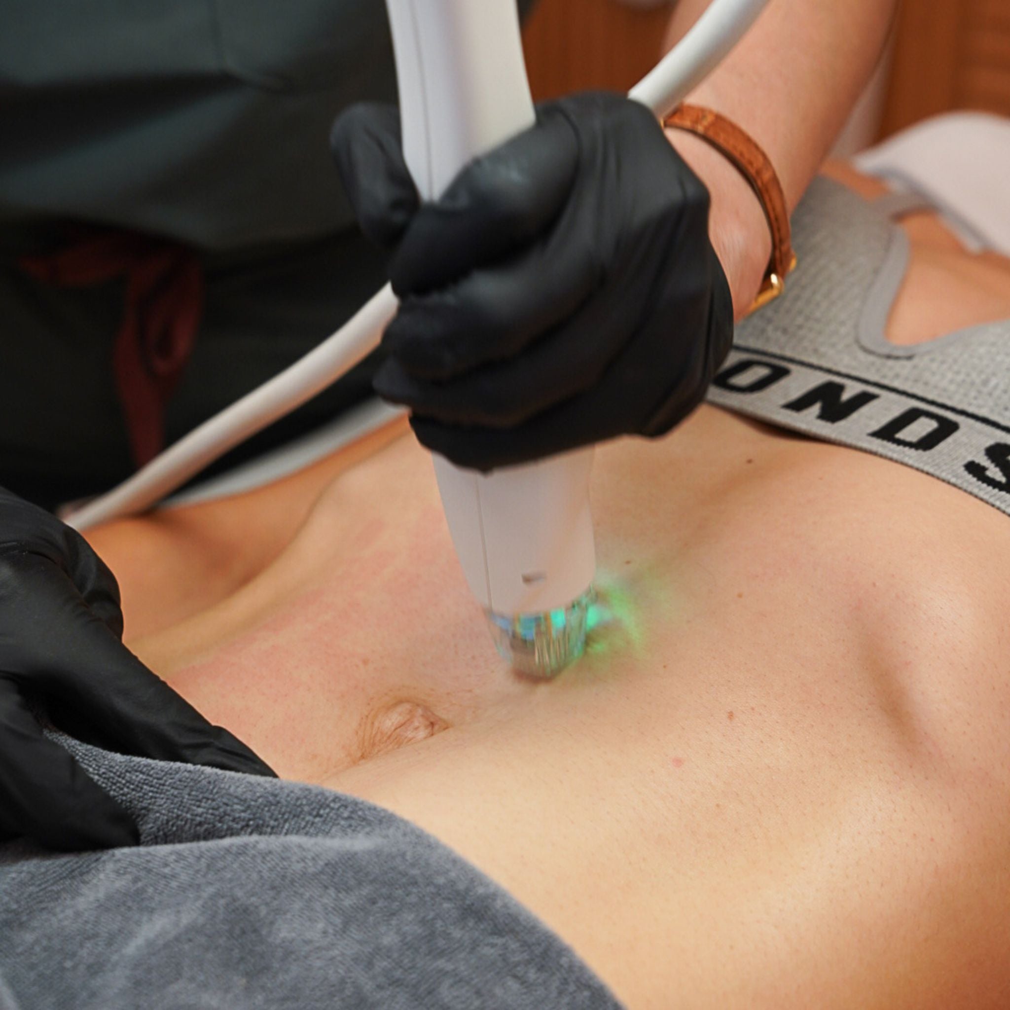 RF Microneedling- Stomach