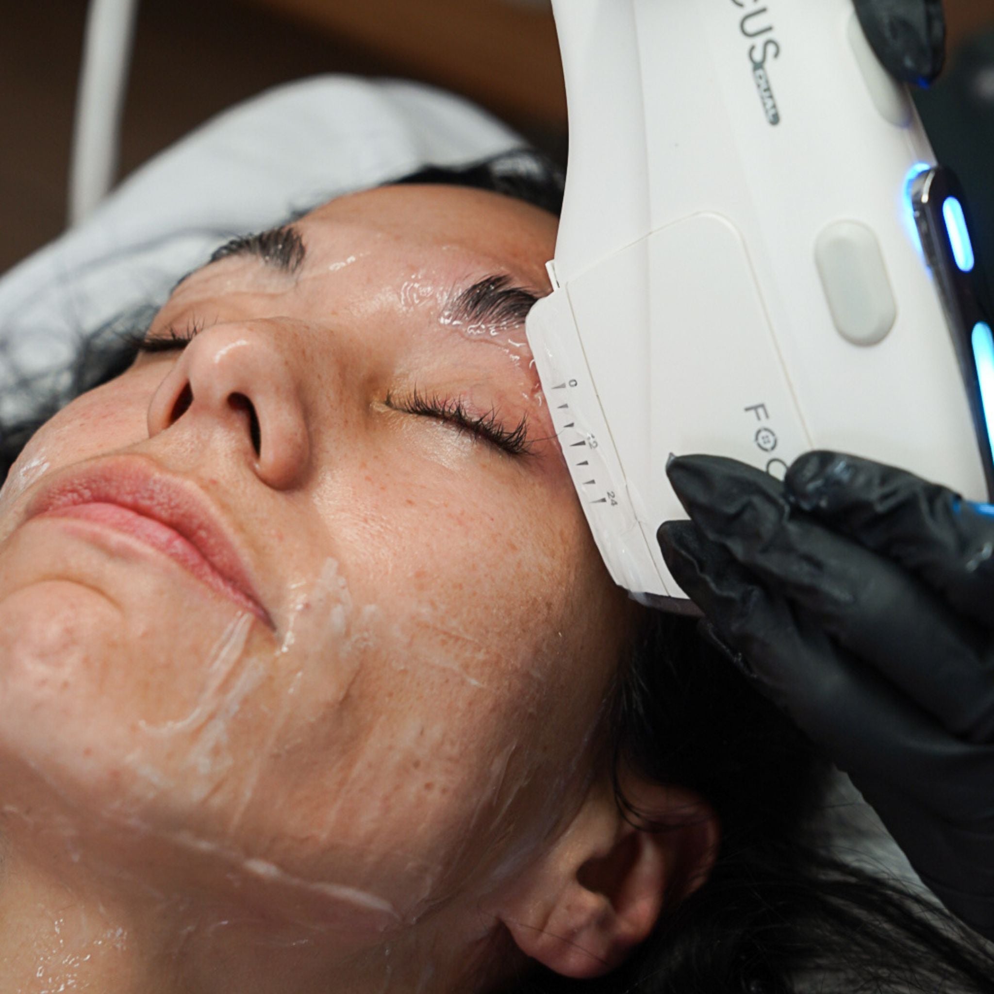 HIFU Non-Surgical Brow Lift
