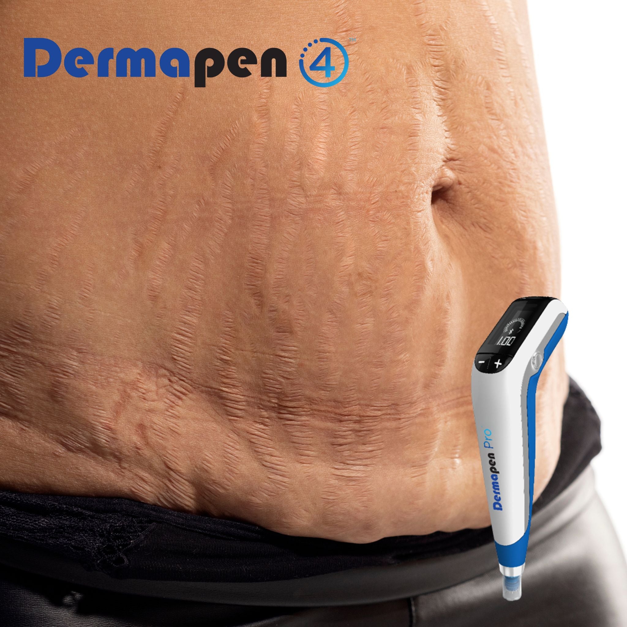 Dermapen®4 Microneedling- Stomach (Stretch Marks)