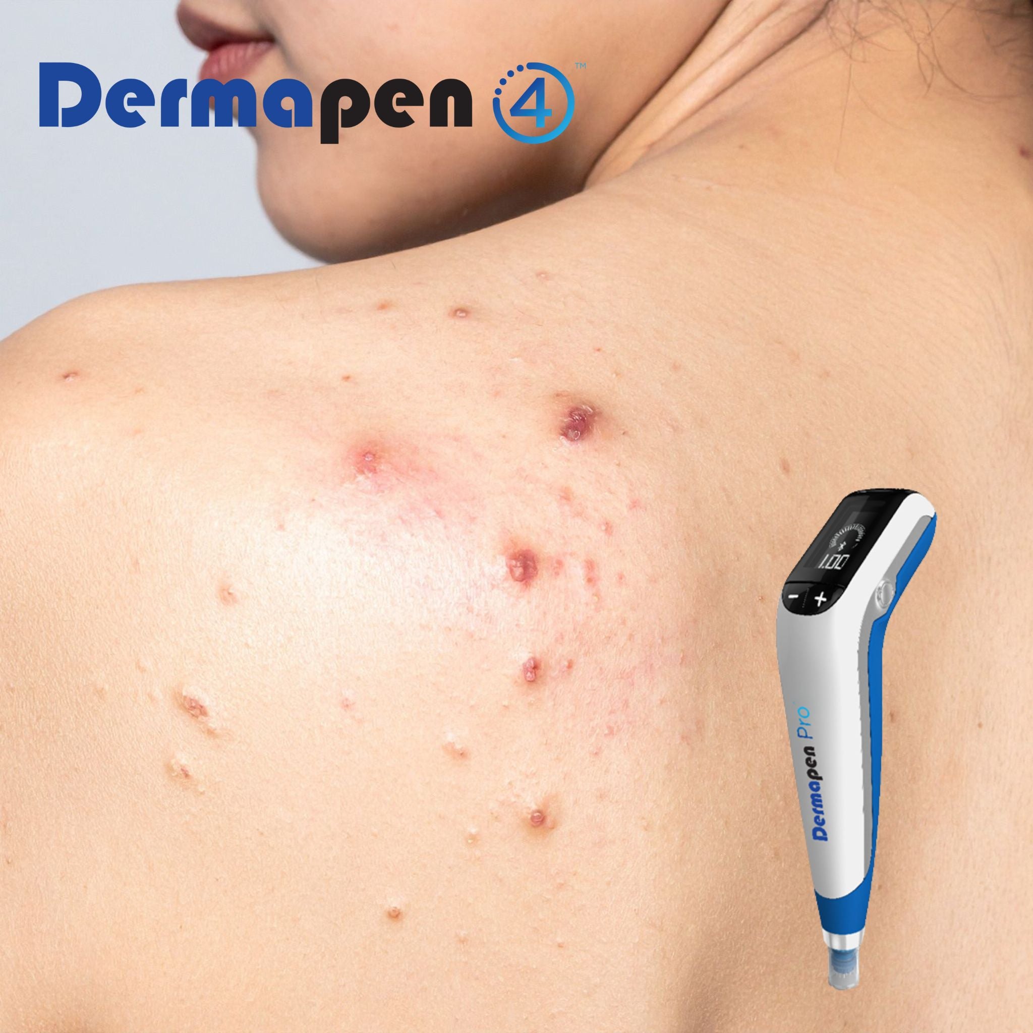 Dermapen®4 Microneedling- Back Acne