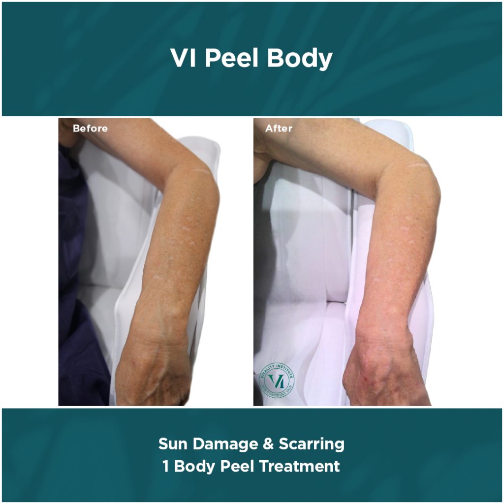 VI Peel® Body