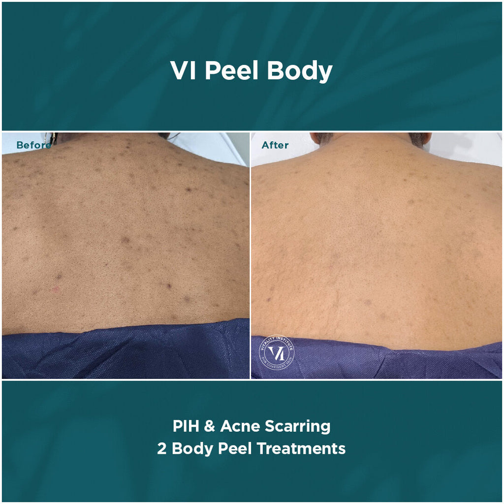 VI Peel® Body