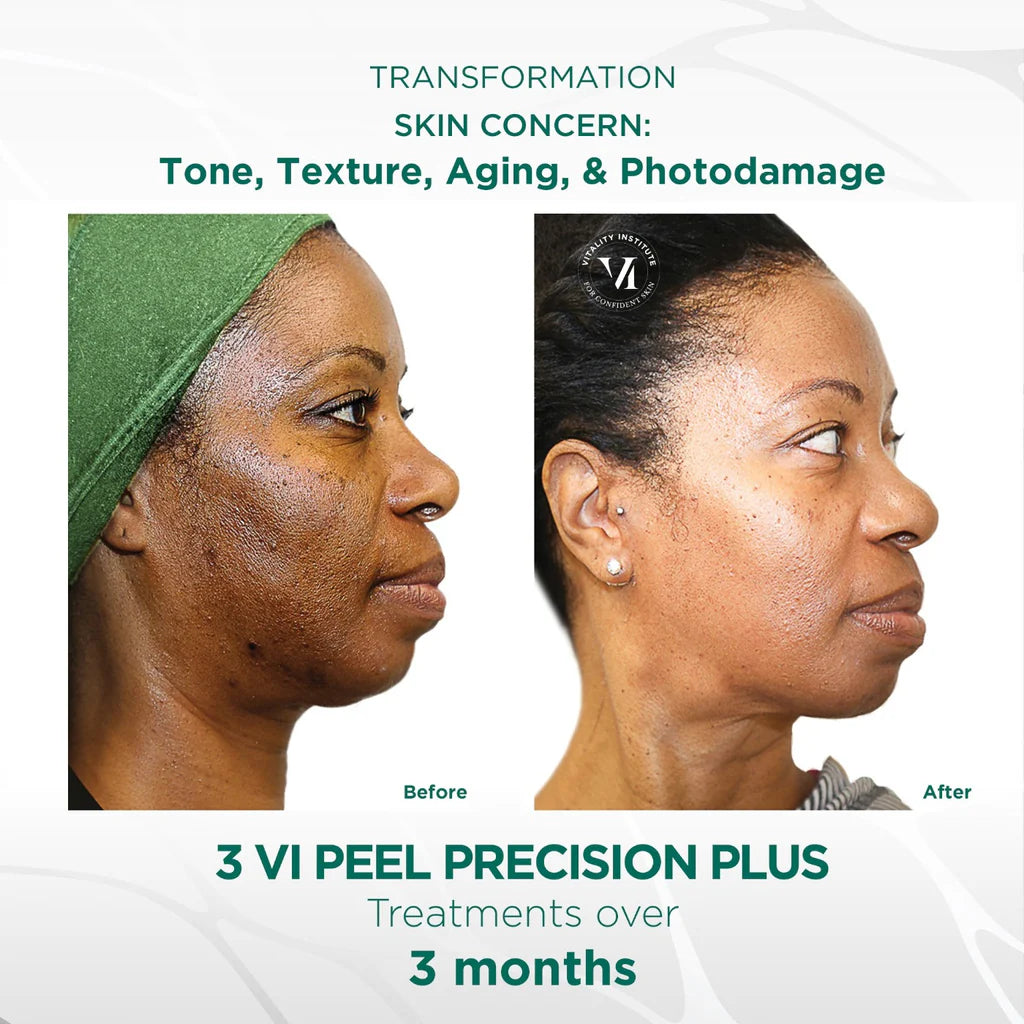 VI Peel® Purity with Precision Plus