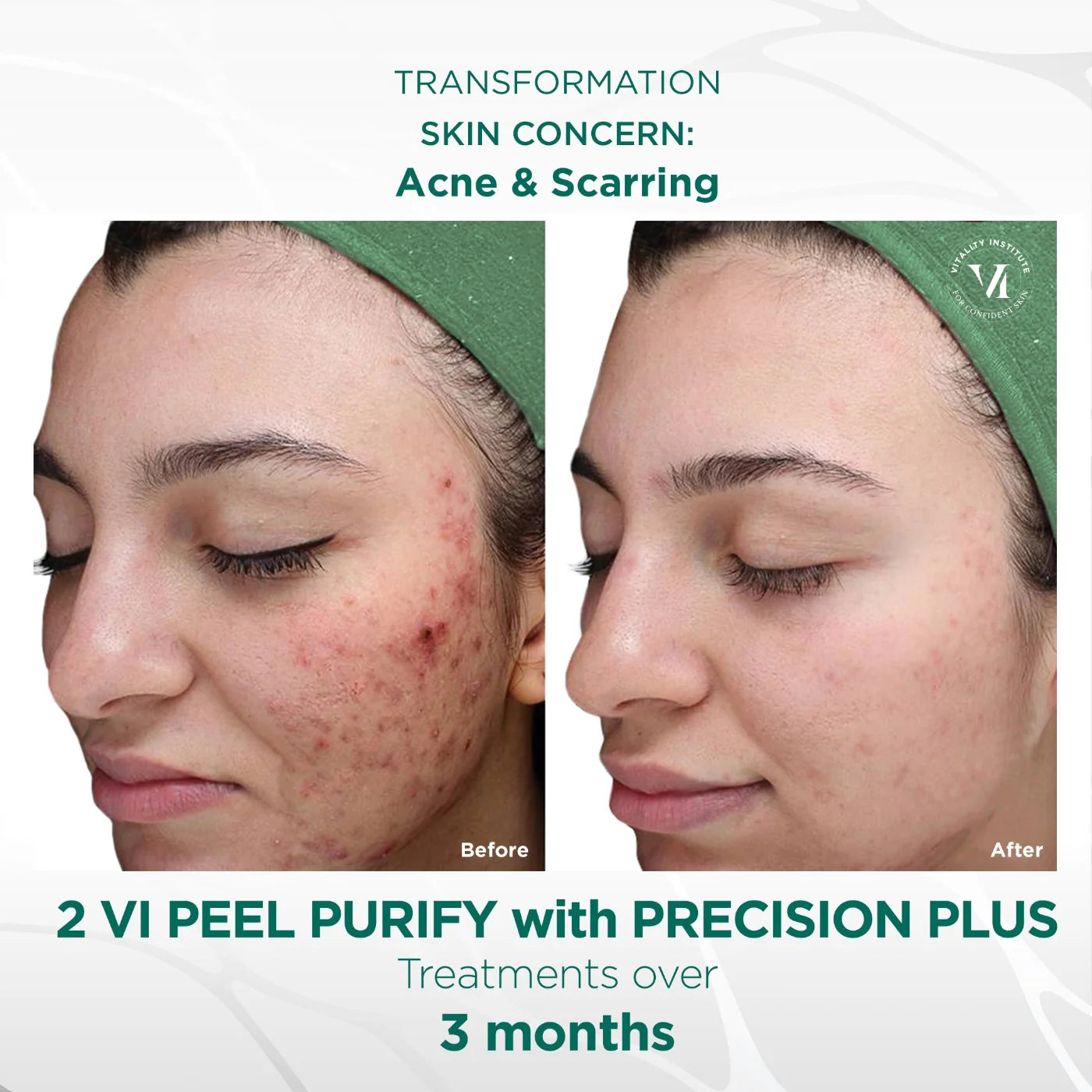 VI Peel® Purity with Precision Plus