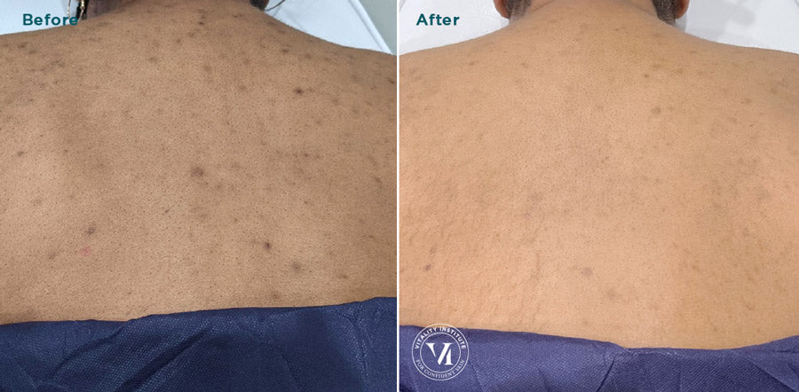 VI Peel® Body