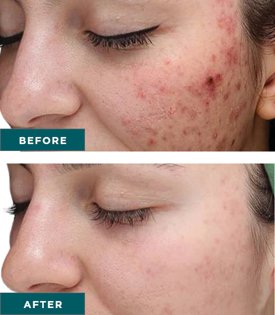 VI Peel® Purity with Precision Plus