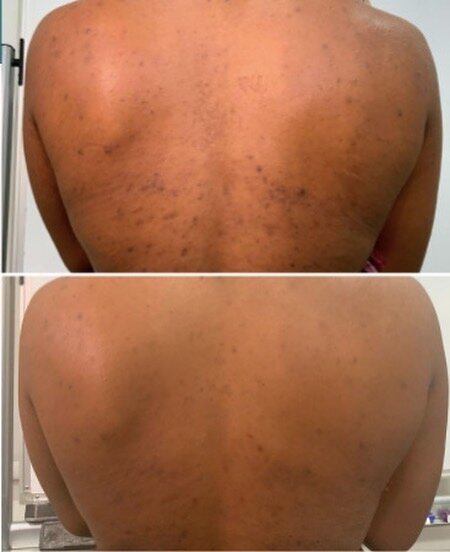 VI Peel® Body