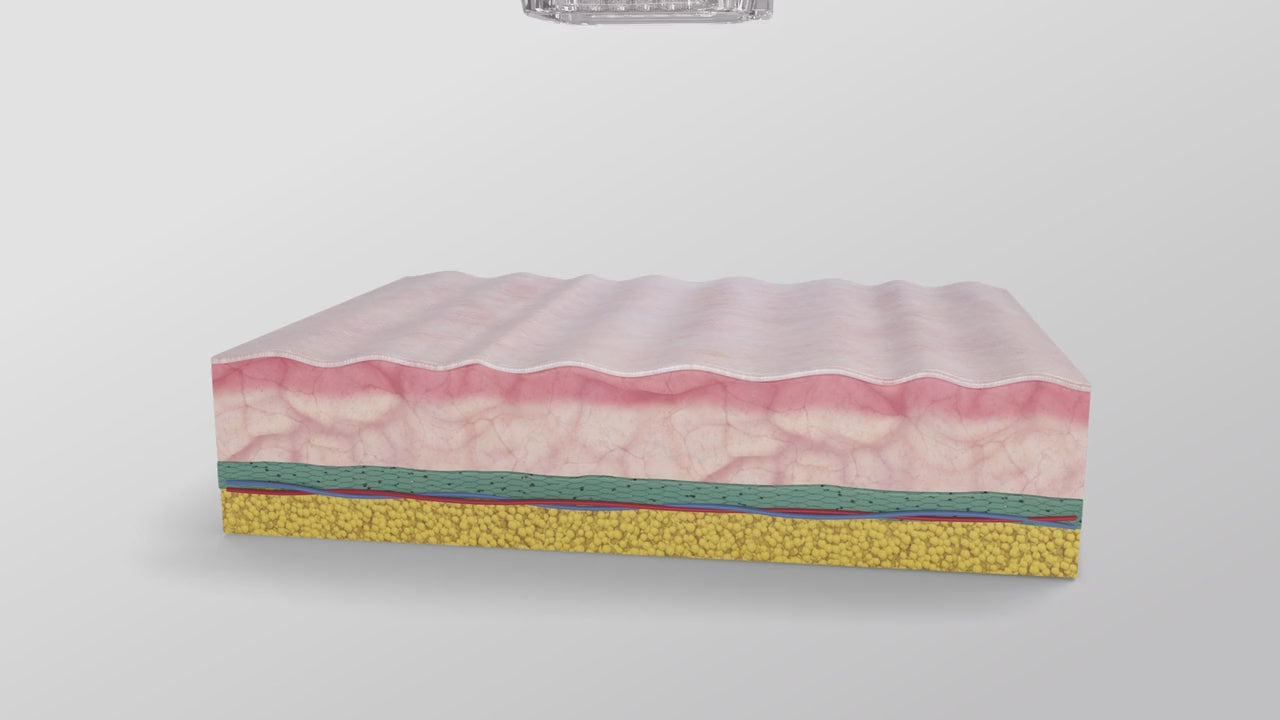 RF Microneedling