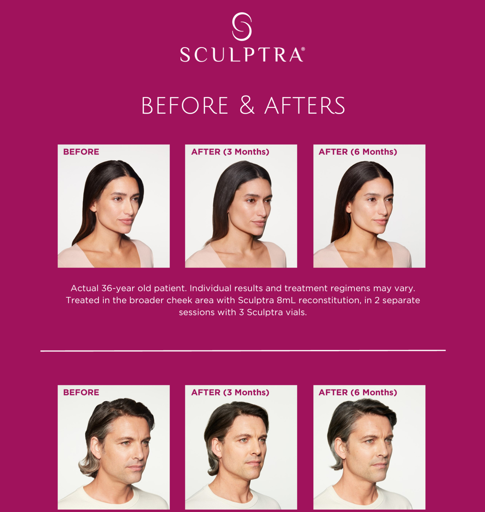 Sculptra®